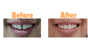 Reduce Gap Between Teeth Naturally